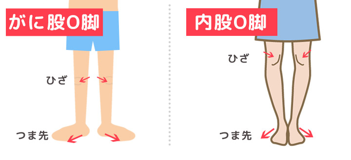 O脚の種類