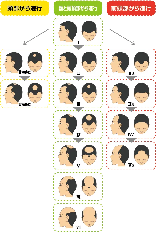 男性頭皮レベル